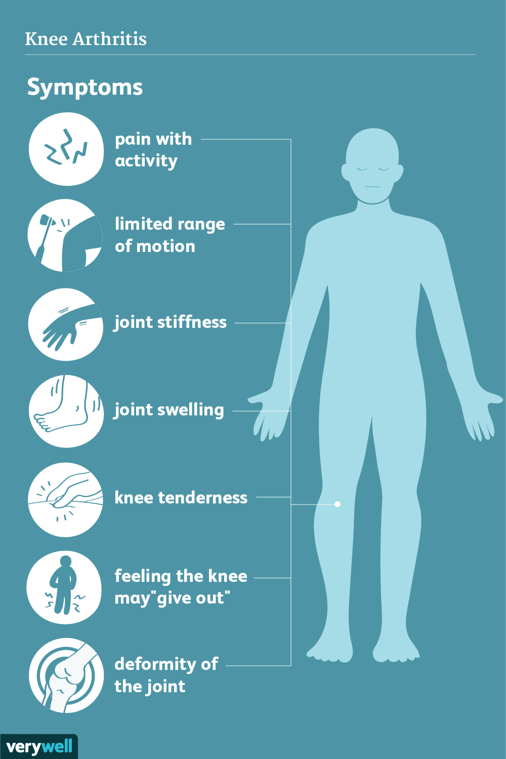 Knee Arthritis: Symptoms & Treatment - News Directory 3